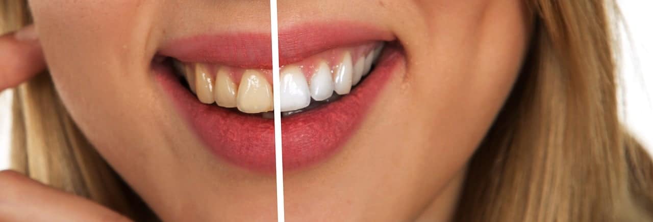 Jak poprawić kolor zębów?